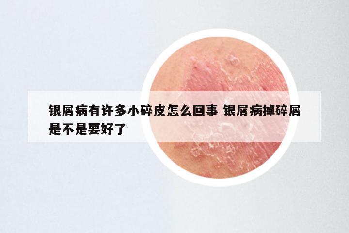 银屑病有许多小碎皮怎么回事 银屑病掉碎屑是不是要好了