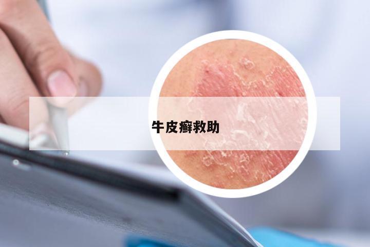 牛皮癣救助