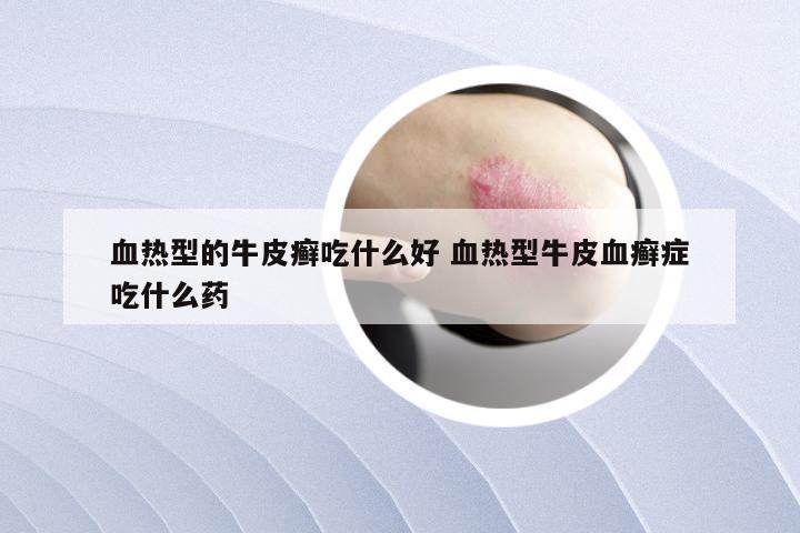 血热型的牛皮癣吃什么好 血热型牛皮血癣症吃什么药