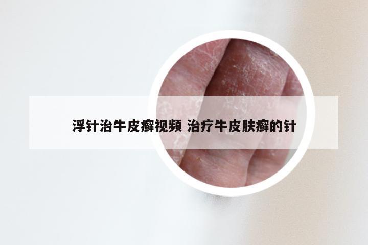 浮针治牛皮癣视频 治疗牛皮肤癣的针