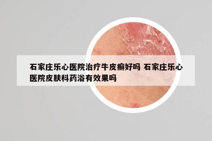 石家庄乐心医院治疗牛皮癣好吗 石家庄乐心医院皮肤科药浴有效果吗
