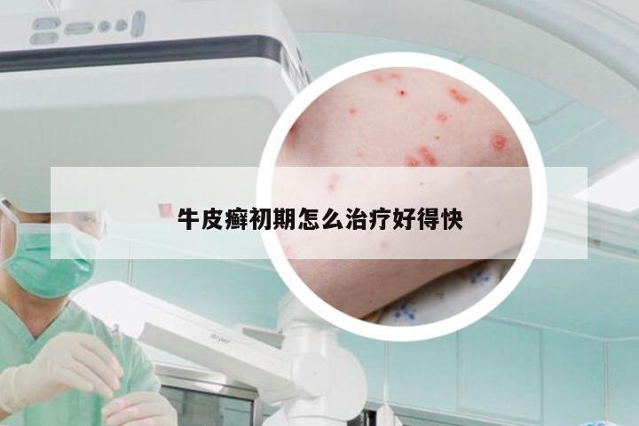 牛皮癣初期怎么治疗好得快