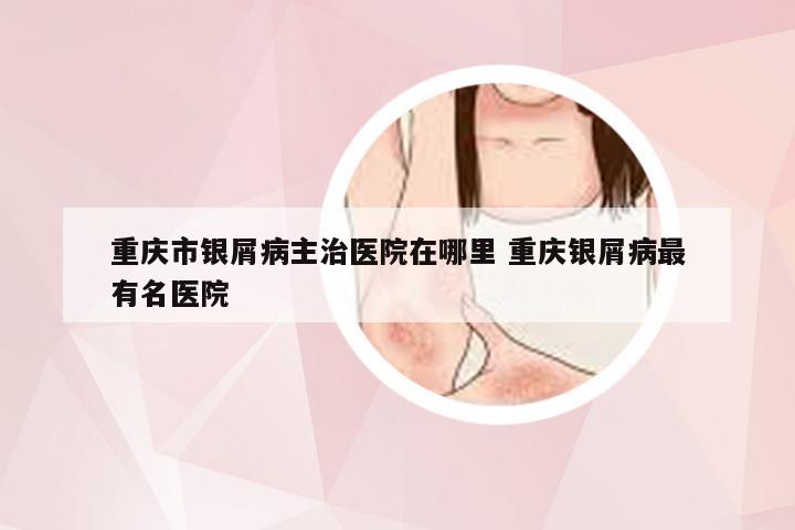 重庆市银屑病主治医院在哪里 重庆银屑病最有名医院