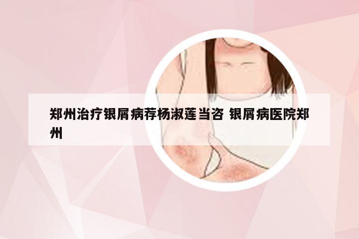 郑州治疗银屑病荐杨淑莲当咨 银屑病医院郑州