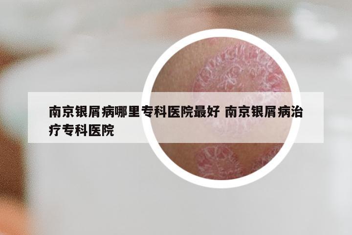 南京银屑病哪里专科医院最好 南京银屑病治疗专科医院