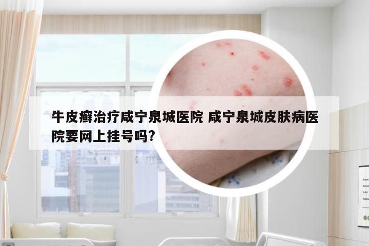 牛皮癣治疗咸宁泉城医院 咸宁泉城皮肤病医院要网上挂号吗?