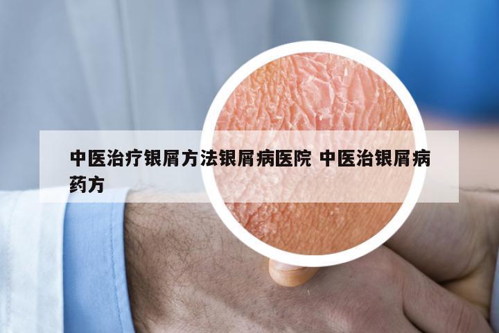 中医治疗银屑方法银屑病医院 中医治银屑病药方