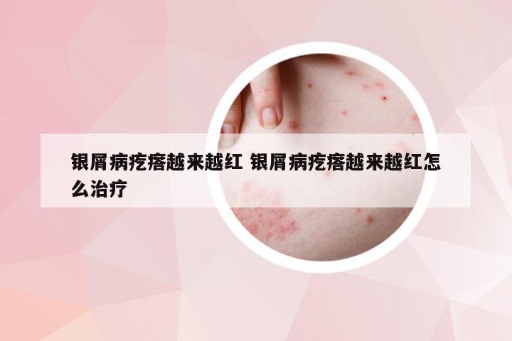 银屑病疙瘩越来越红 银屑病疙瘩越来越红怎么治疗