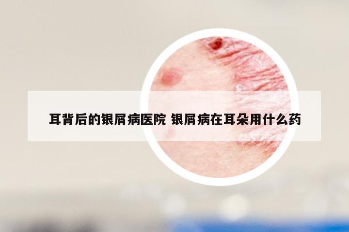 耳背后的银屑病医院 银屑病在耳朵用什么药