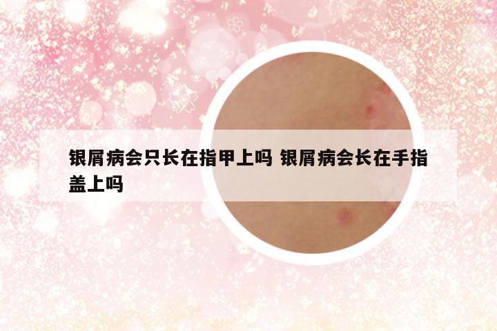 银屑病会只长在指甲上吗 银屑病会长在手指盖上吗