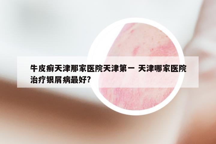 牛皮癣天津那家医院天津第一 天津哪家医院治疗银屑病最好?