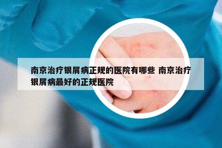 南京治疗银屑病正规的医院有哪些 南京治疗银屑病最好的正规医院
