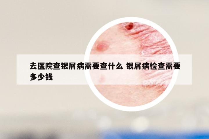 去医院查银屑病需要查什么 银屑病检查需要多少钱