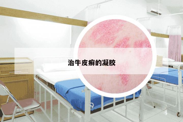 治牛皮癣的凝胶