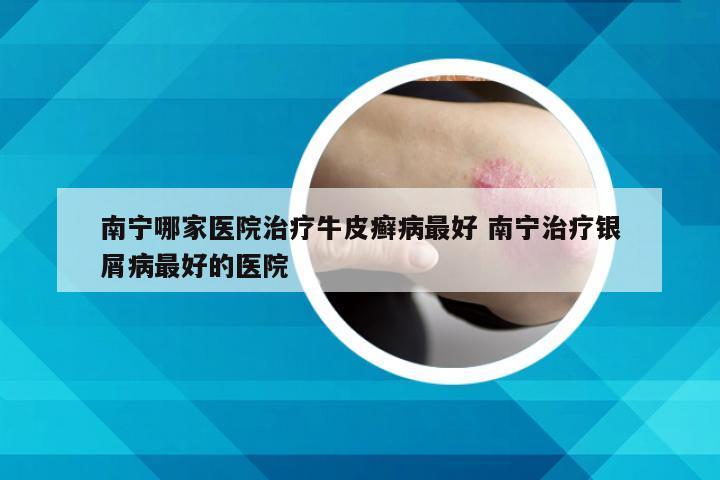 南宁哪家医院治疗牛皮癣病最好 南宁治疗银屑病最好的医院