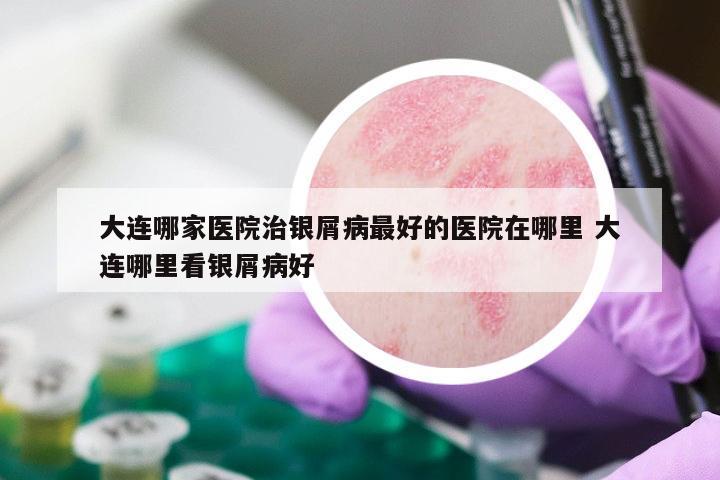 大连哪家医院治银屑病最好的医院在哪里 大连哪里看银屑病好