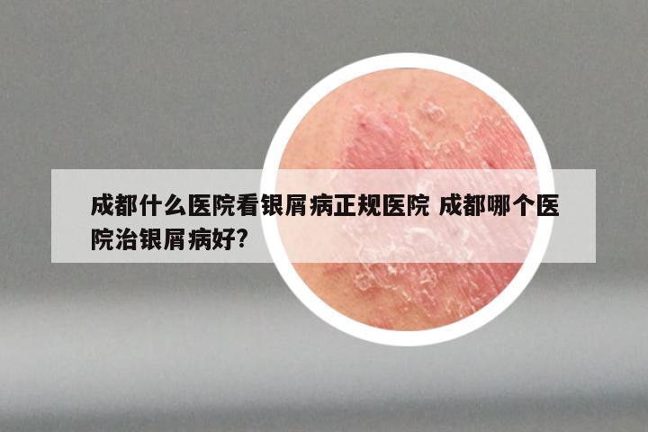 成都什么医院看银屑病正规医院 成都哪个医院治银屑病好?