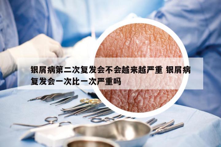银屑病第二次复发会不会越来越严重 银屑病复发会一次比一次严重吗