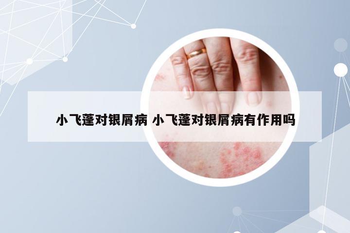 小飞蓬对银屑病 小飞蓬对银屑病有作用吗