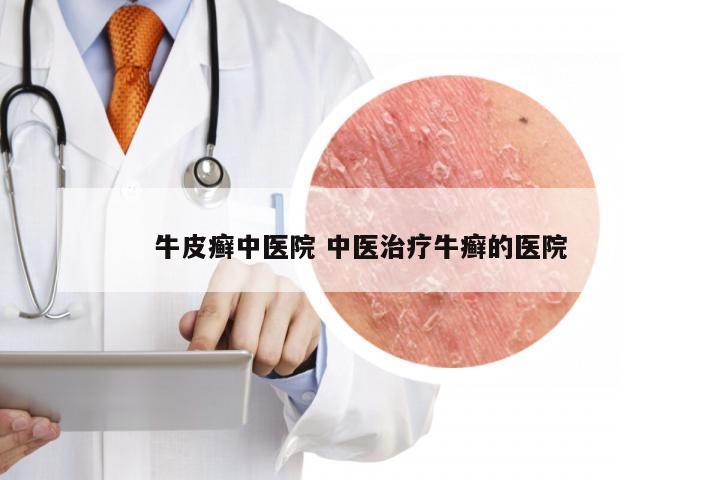 牛皮癣中医院 中医治疗牛癣的医院