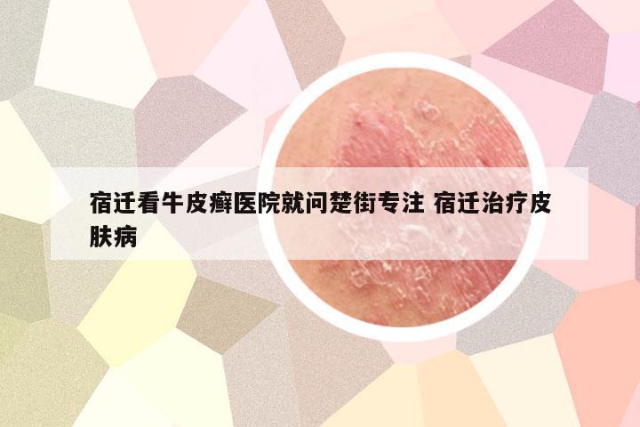 宿迁看牛皮癣医院就问楚街专注 宿迁治疗皮肤病