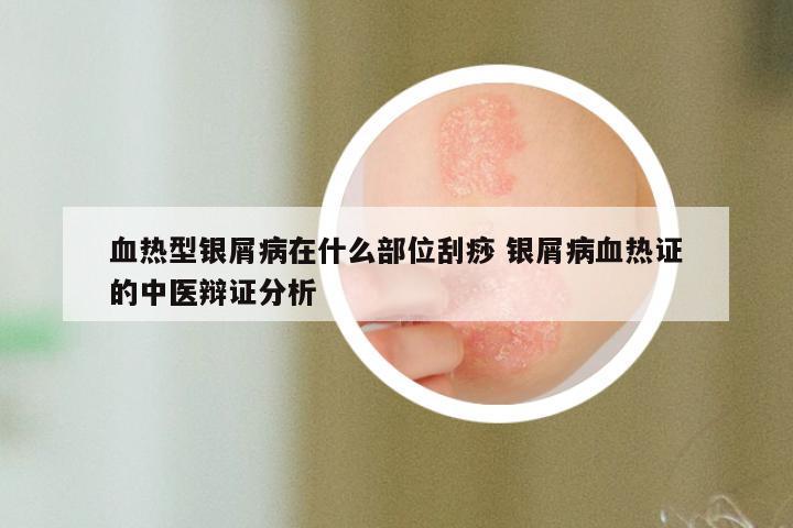 血热型银屑病在什么部位刮痧 银屑病血热证的中医辩证分析