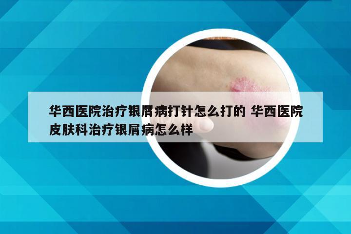 华西医院治疗银屑病打针怎么打的 华西医院皮肤科治疗银屑病怎么样