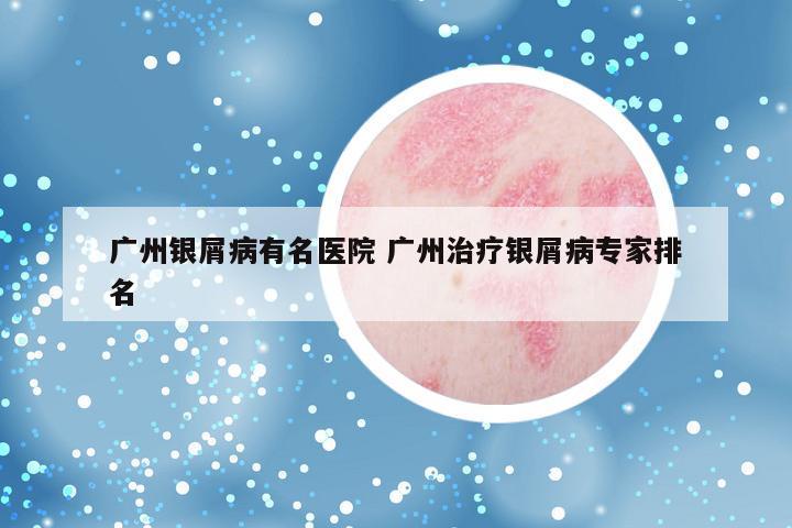 广州银屑病有名医院 广州治疗银屑病专家排名