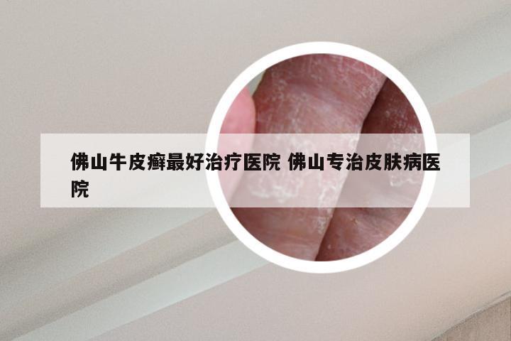 佛山牛皮癣最好治疗医院 佛山专治皮肤病医院