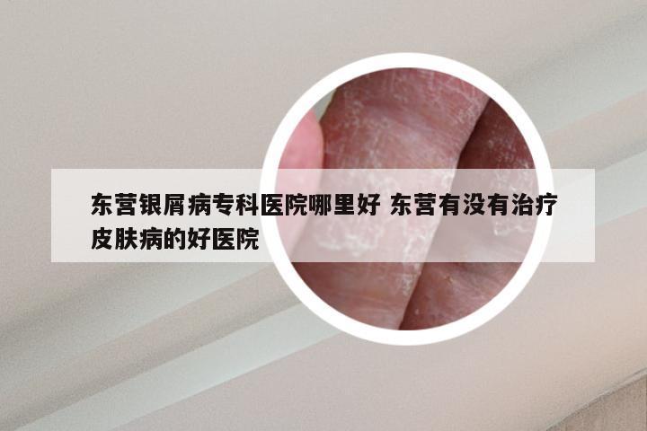 东营银屑病专科医院哪里好 东营有没有治疗皮肤病的好医院