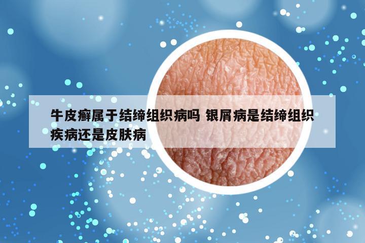 牛皮癣属于结缔组织病吗 银屑病是结缔组织疾病还是皮肤病