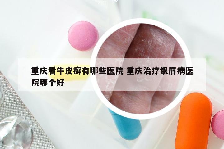 重庆看牛皮癣有哪些医院 重庆治疗银屑病医院哪个好