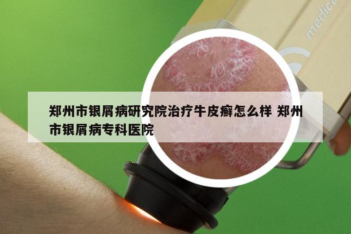 郑州市银屑病研究院治疗牛皮癣怎么样 郑州市银屑病专科医院