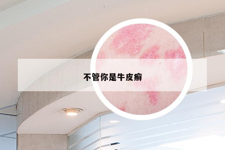 不管你是牛皮癣