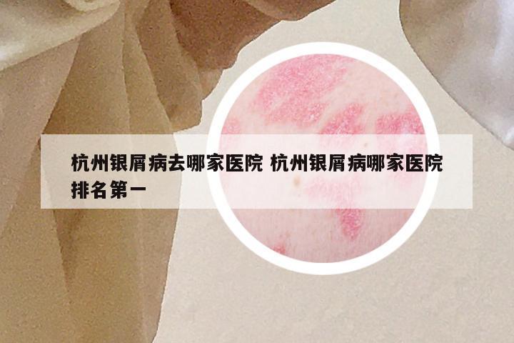 杭州银屑病去哪家医院 杭州银屑病哪家医院排名第一