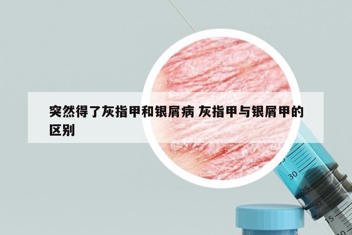 突然得了灰指甲和银屑病 灰指甲与银屑甲的区别