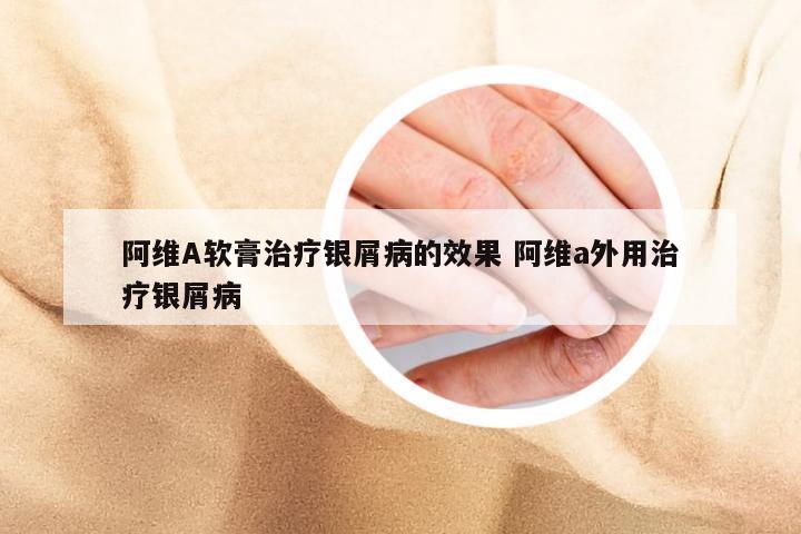 阿维A软膏治疗银屑病的效果 阿维a外用治疗银屑病