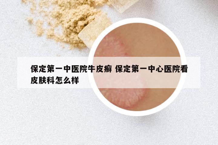 保定第一中医院牛皮癣 保定第一中心医院看皮肤科怎么样