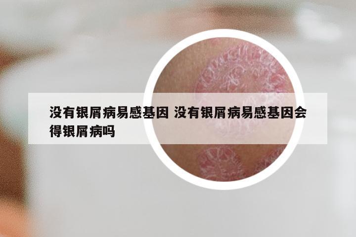 没有银屑病易感基因 没有银屑病易感基因会得银屑病吗