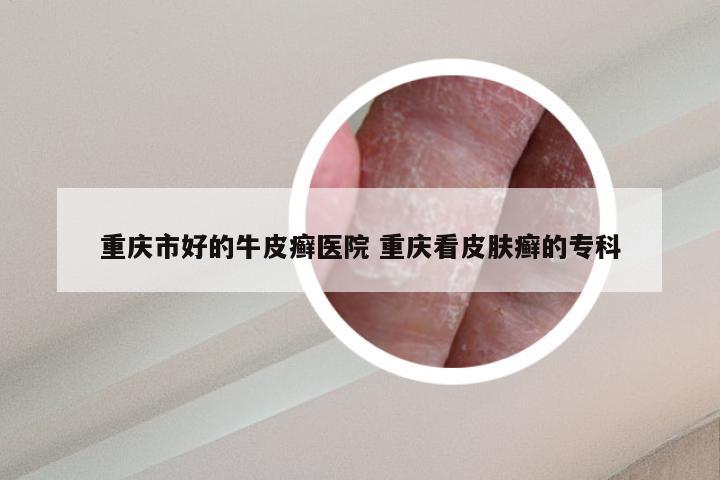 重庆市好的牛皮癣医院 重庆看皮肤癣的专科