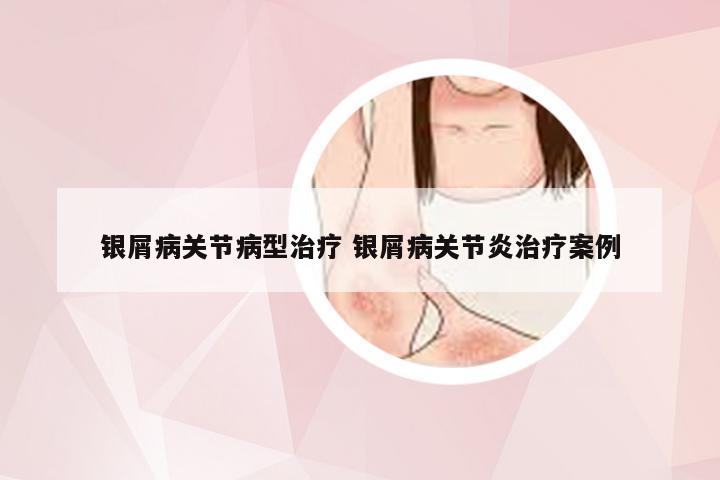 银屑病关节病型治疗 银屑病关节炎治疗案例