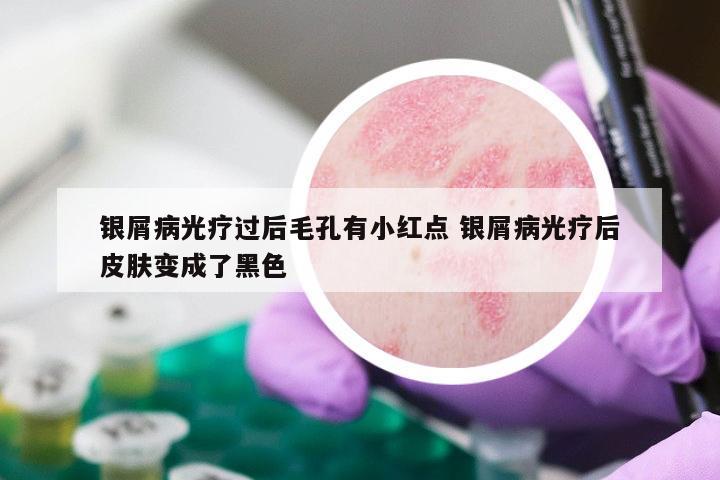 银屑病光疗过后毛孔有小红点 银屑病光疗后皮肤变成了黑色