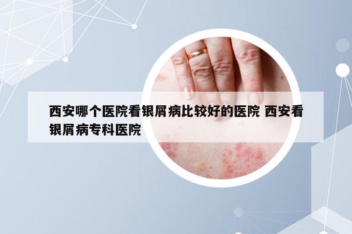 西安哪个医院看银屑病比较好的医院 西安看银屑病专科医院