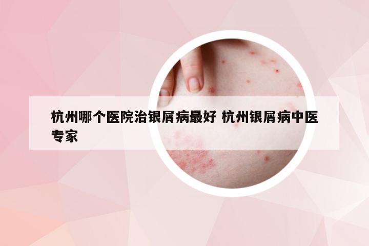 杭州哪个医院治银屑病最好 杭州银屑病中医专家