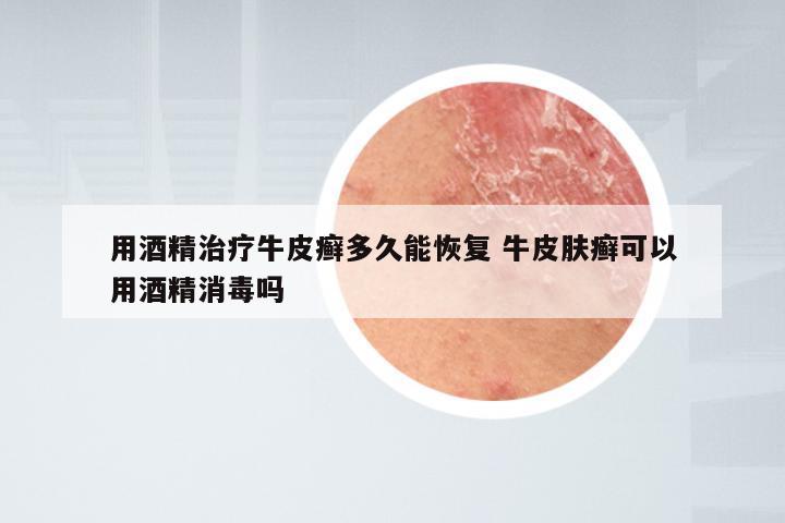 用酒精治疗牛皮癣多久能恢复 牛皮肤癣可以用酒精消毒吗