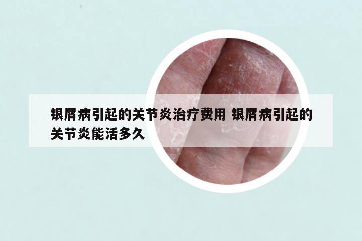 银屑病引起的关节炎治疗费用 银屑病引起的关节炎能活多久