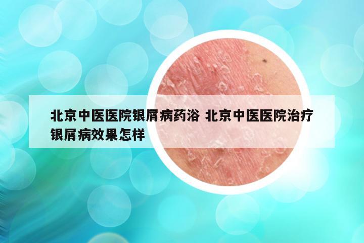 北京中医医院银屑病药浴 北京中医医院治疗银屑病效果怎样