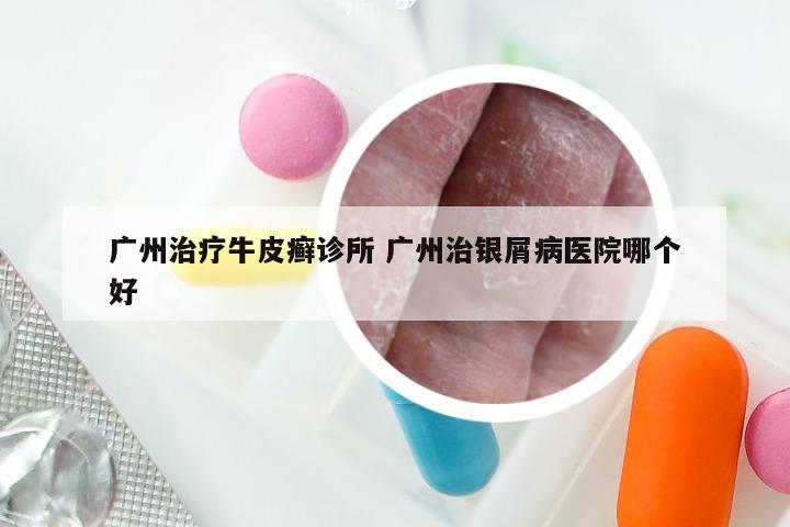 广州治疗牛皮癣诊所 广州治银屑病医院哪个好