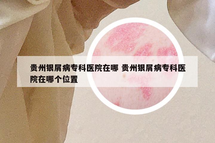 贵州银屑病专科医院在哪 贵州银屑病专科医院在哪个位置
