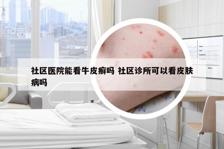 社区医院能看牛皮癣吗 社区诊所可以看皮肤病吗